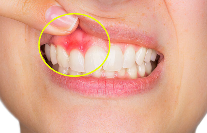 maladies_gingivales